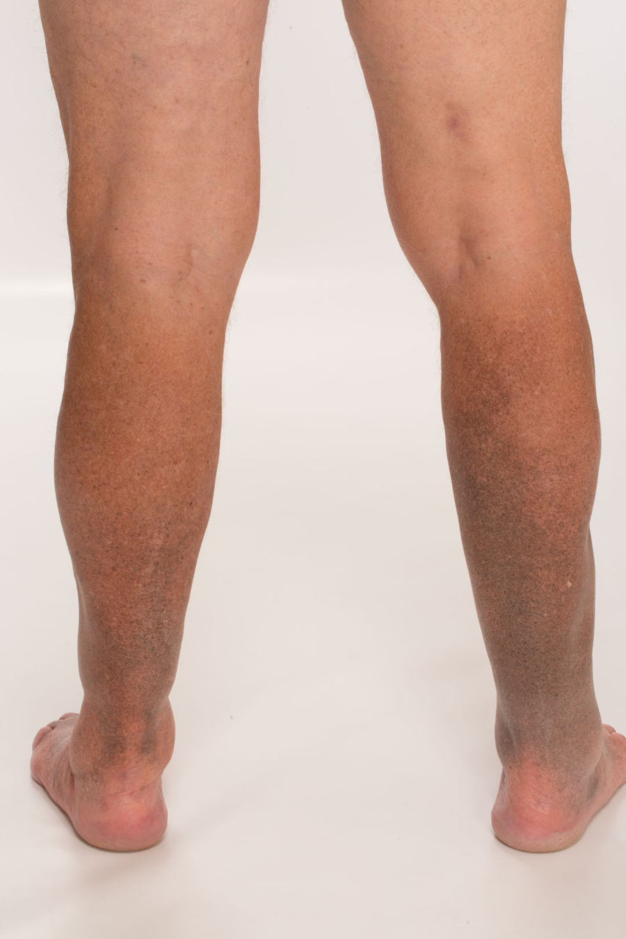 A 77-Year-Old with Cutaneous Hyperpigmentation and Lower Extremity